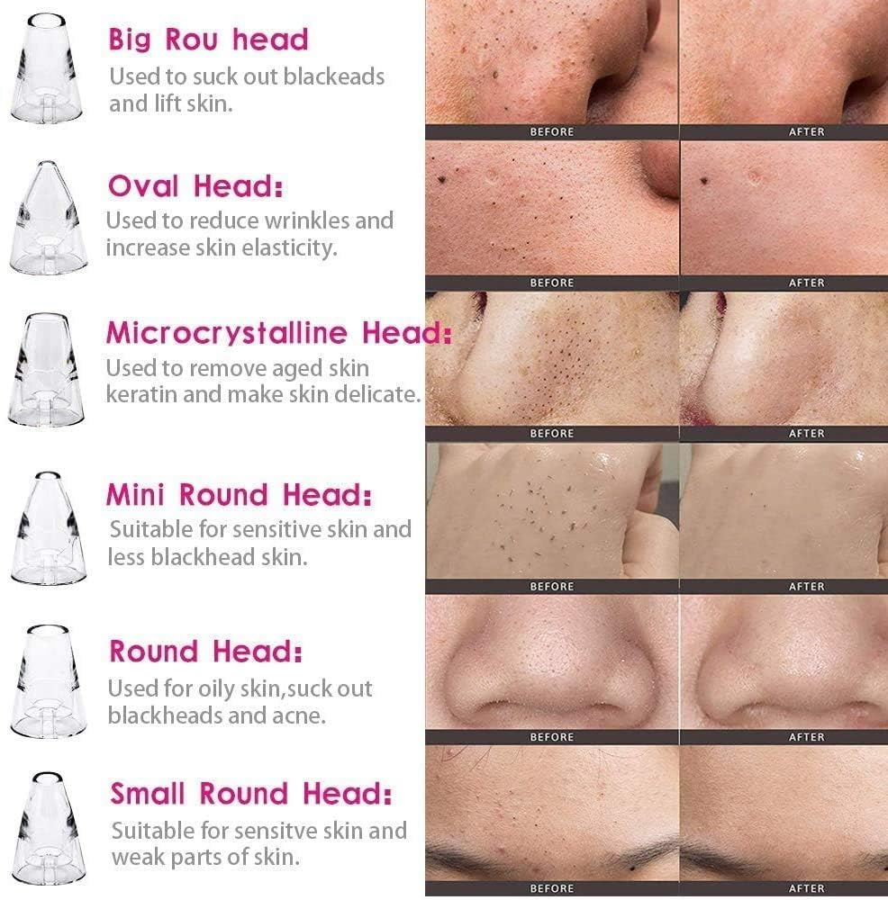 6-in-1 Blackhead Remover Vacuum – Electric Pore Cleaner with 3 Suction Levels | USB Rechargeable Acne & Deep Skin Care Tool