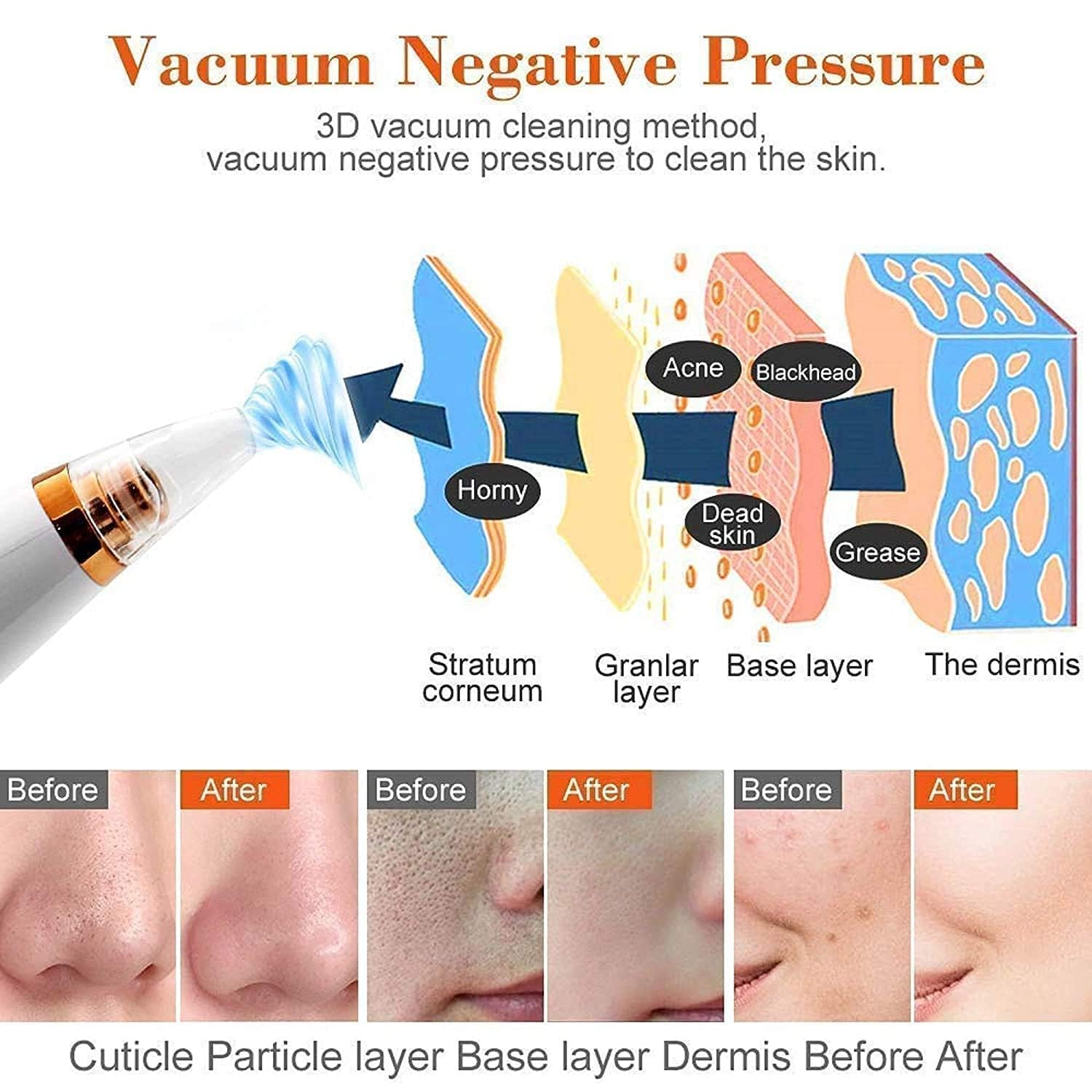 6-in-1 Blackhead Remover Vacuum – Electric Pore Cleaner with 3 Suction Levels | USB Rechargeable Acne & Deep Skin Care Tool